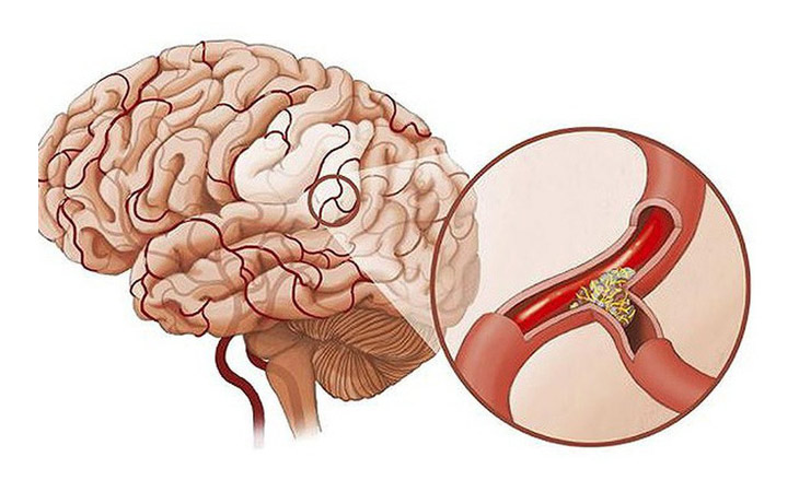 Viêm tai giữa ứ dịch có thể dẫn bệnh viêm màng não