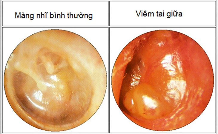 Bệnh viêm tai giữa gây ra nhiều phiền toái trong cuộc sống của người bệnh