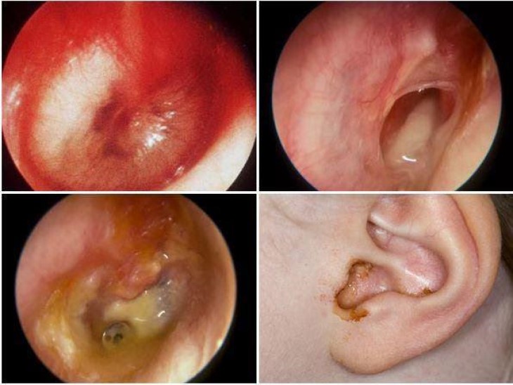 Nếu không được phát hiện sớm và điều trị kịp thời thì viêm tai giữa cấp tính sẽ tiến triển thành viêm tai giữa mãn tính