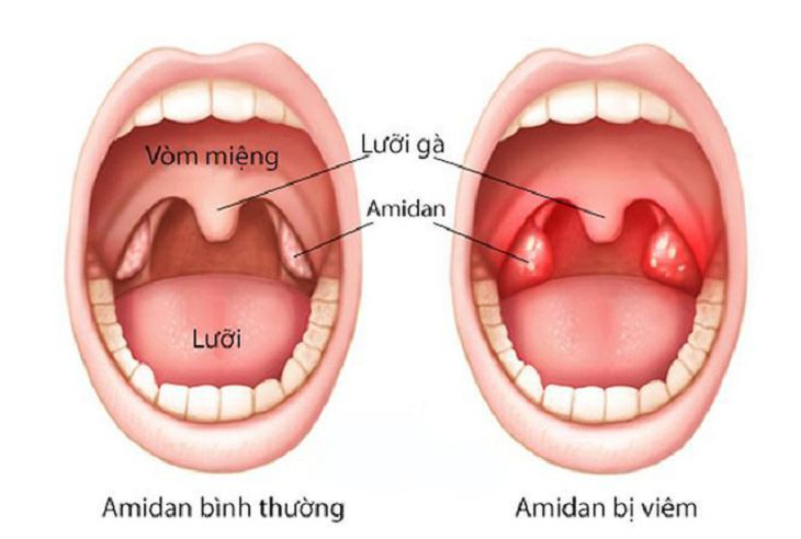 Các khối amidan phân bố quanh vòm họng tạo thành vòng bạch huyết
