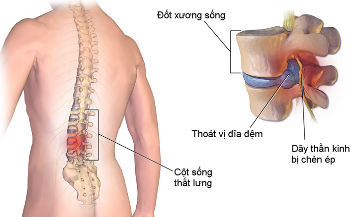 Chứng yếu thông gây ra bởi tình trạng ứ trệ khí huyết