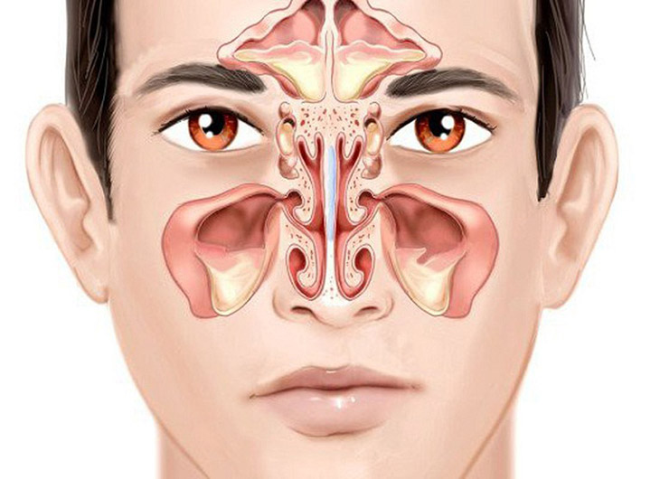 Người bị viêm xoang mũi thường có biểu hiện sưng nhức ở vùng mũi, tắc nghẹt, chảy dịch mũi,