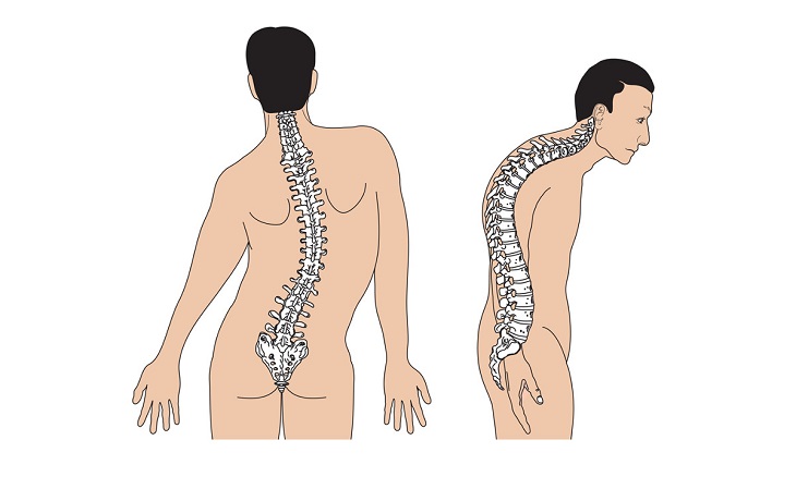 Thoát vị đĩa đệm có thể khiến người bệnh vẹo cột sống