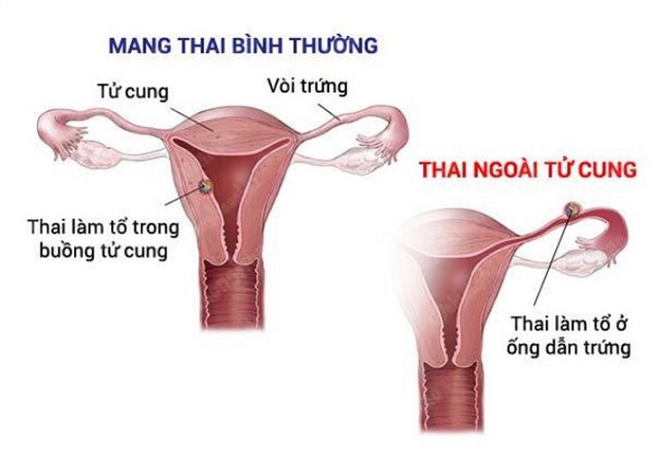 Viêm phần phụ dễ gây thai ngoài tử cung