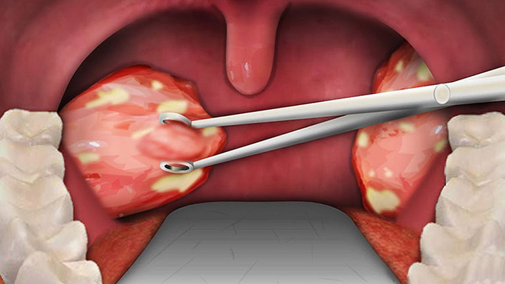 Phẫu thuật cắt bỏ amidan điều trị dứt điểm hiệu quả nhất