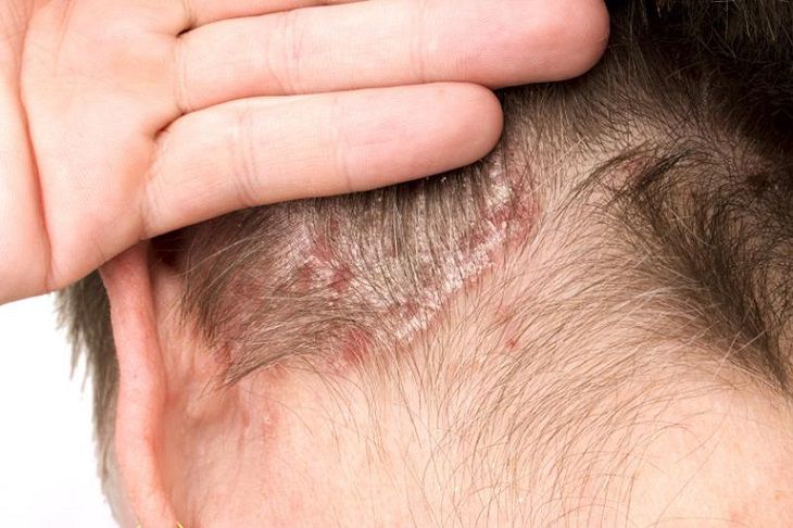 Bệnh vảy nến gây ngứa rát da đầu