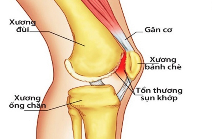 Thoái hóa cột sống có nguy hiểm không là thắc mắc của nhiều người bệnh khi tổn thương khớp xảy ra