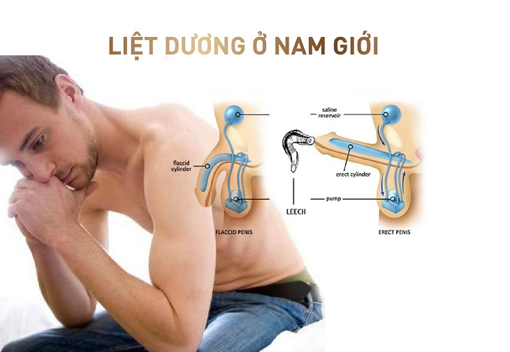 Tình trạng liệt dương ở nam giới ảnh hưởng nhiều đến sức khỏe và tâm lý phái mạnh 