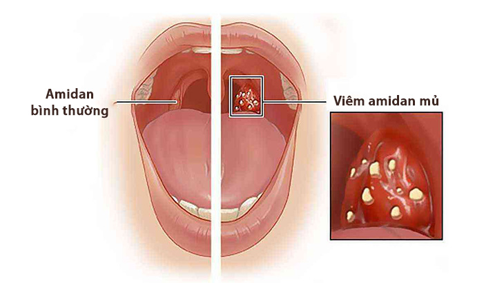 Amidan dễ dàng bị viêm vì phải tiếp xúc nhiều với mầm bệnh