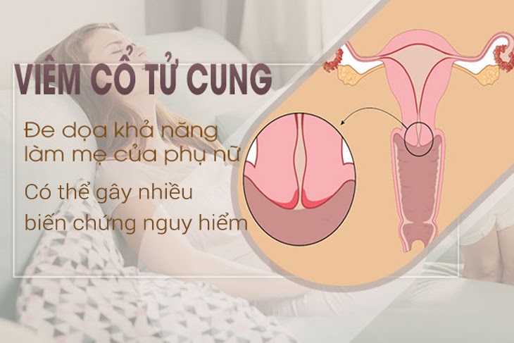 Viêm lộ tuyến cổ tử cung nguy hiểm không? - dễ vô sinh hiếm muộn