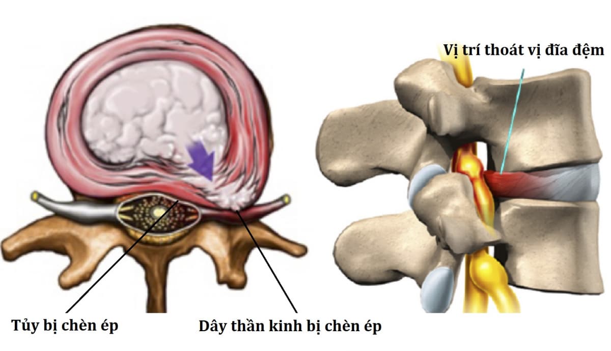 Thoát vị đĩa đệm là căn bệnh phổ biến sẽ gây nguy hiểm nếu không được điều trị sớm