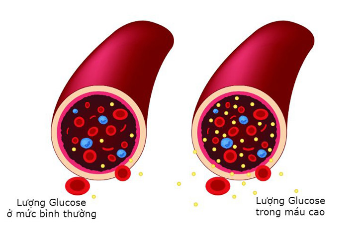 Bệnh tiểu đường khiến lượng đường trong máu cao bất thường