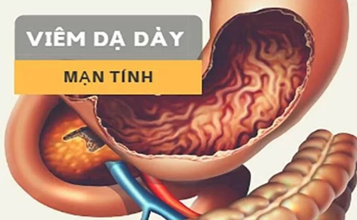 Biến chứng nghiêm trọng gây viêm dạ dày mạn tính