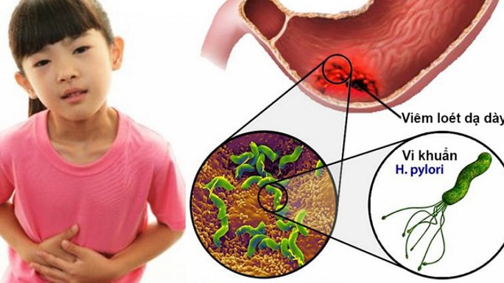 Chẩn đoán vi khuẩn HP ở trẻ em để phát hiện và điều trị bệnh sớm