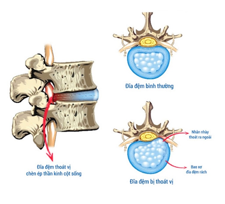Thoát vị đĩa đệm rách vòng xơ là giai đoạn biến chứng nguy hiểm 