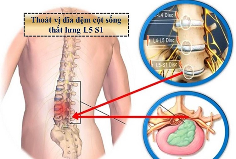 Thoát vị đĩa đệm xương chậu là thoát vị đĩa đệm đốt sống L5-S1