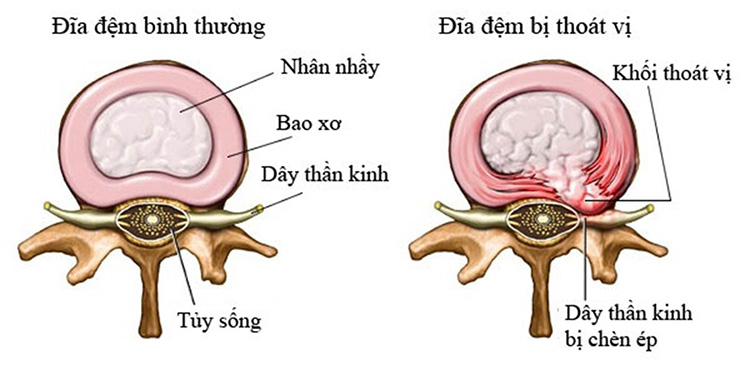 Hình ảnh đĩa đệm thoát vị chèn lên rễ thần kinh