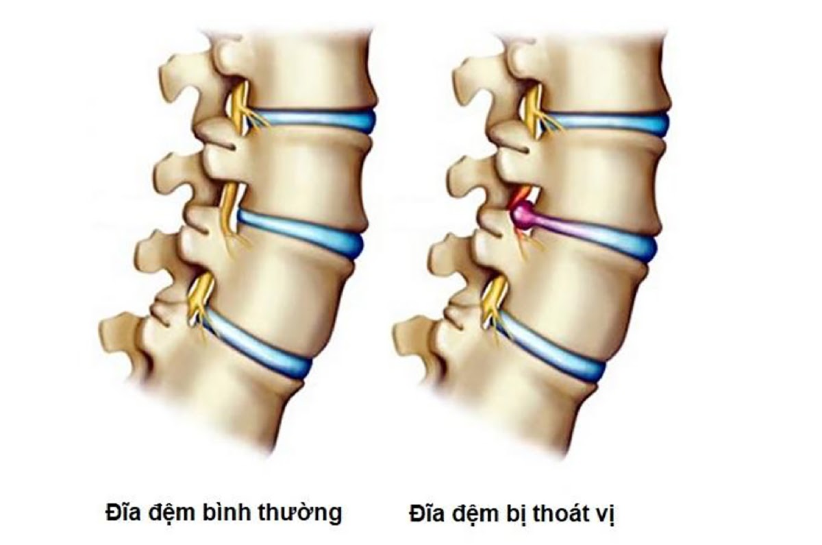 Thoát vị đĩa đệm gây hẹp ống sống