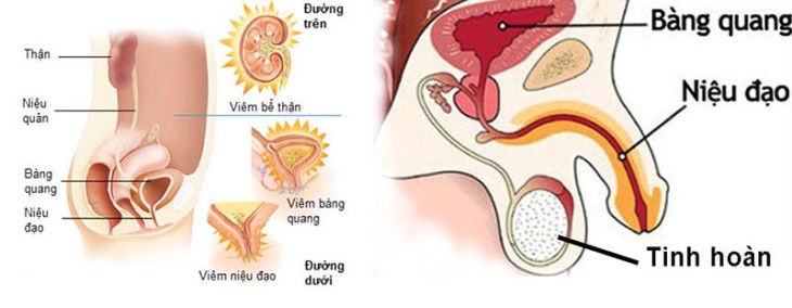 Viêm niệu đạo là bệnh lý có thể xảy ra cả ở nữ giới 