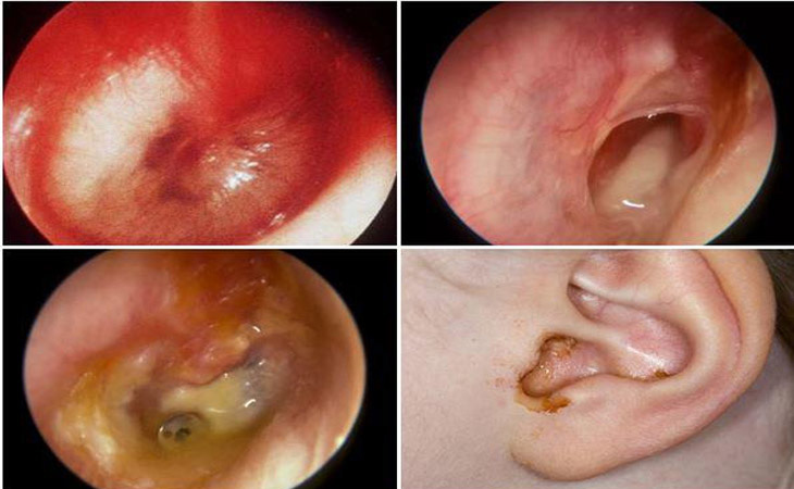Hình ảnh mô tả bệnh viêm tai giữa ở người lớn