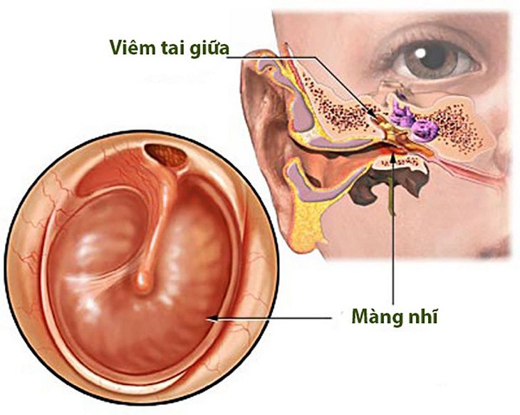 Không được điều trị đúng cách, bệnh có thể tiến triển thành mãn tính