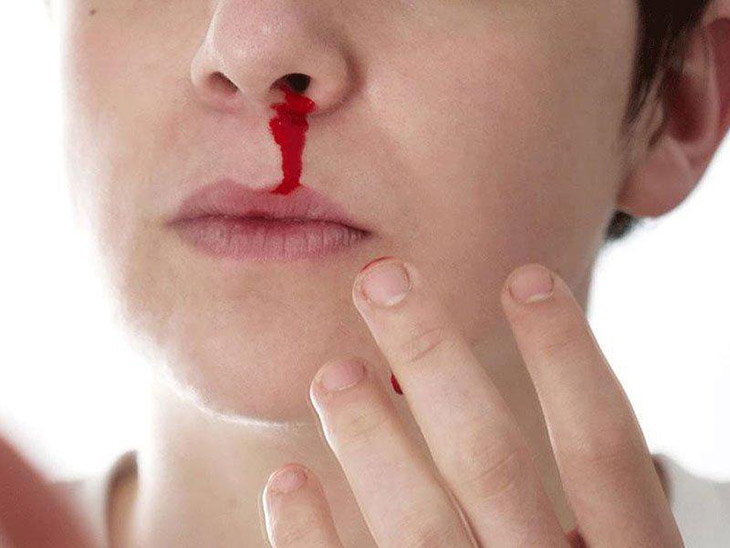 Viêm xoang chảy máu mũi phát sinh bởi cả yếu tố nội và ngoại nhân