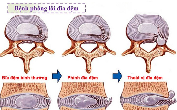 Lồi đĩa đệm là hiện tượng đĩa đệm bị chèn ép, nhân nhầy tràn ra nhiều hướng khác nhau.