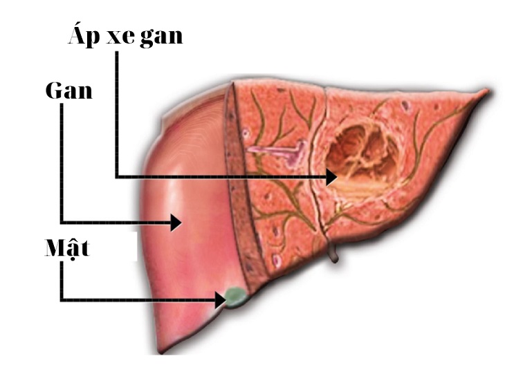 Sỏi đường mật gây biến chứng áp xe gan 