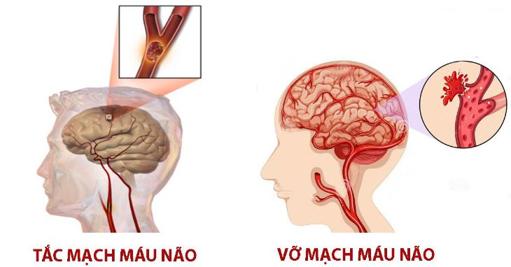 Rối loạn tiền đình tăng nguy cơ tai biến mạch máu não