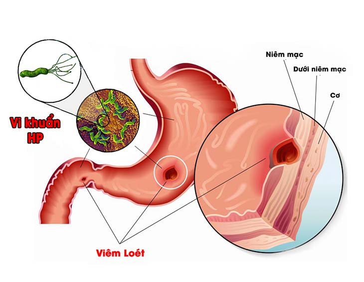 Quan sát hình ảnh nội soi sẽ nhận diện vết trợt loét dạ dày rõ hơn