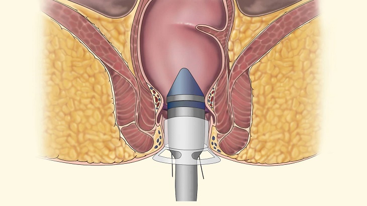 Các cách mổ trĩ hiện đại thường không đau, ít chảy máu nhưng khá tốn kém