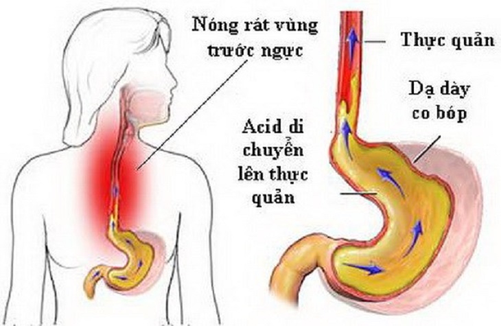 Có rất nhiều nguyên nhân khiến cho dịch vị bị trào ngược lên trên thực quản