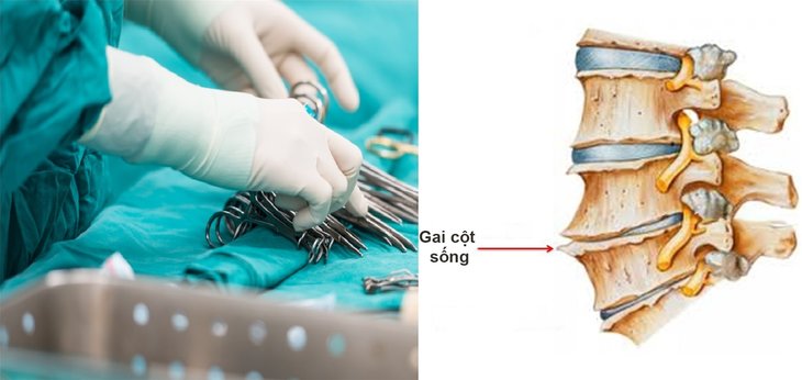 Các phương pháp phẫu thuật phổ biến hiện nay