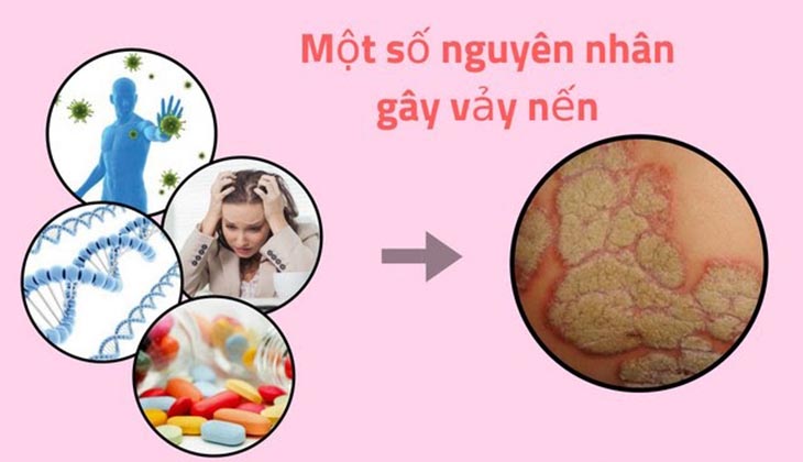 Một số nguyên nhân gây bệnh vảy nến ở tay