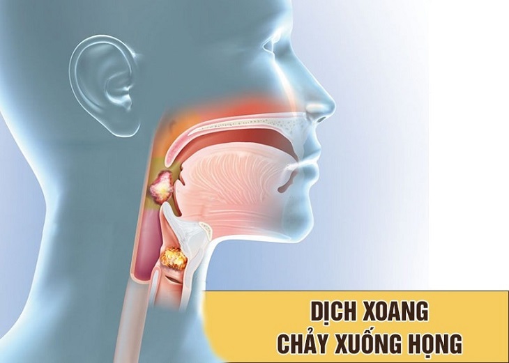 Viêm xoang cấp có thể gây sốt rất cao cùng với những triệu chứng chảy dịch mủ chảy xuống họng