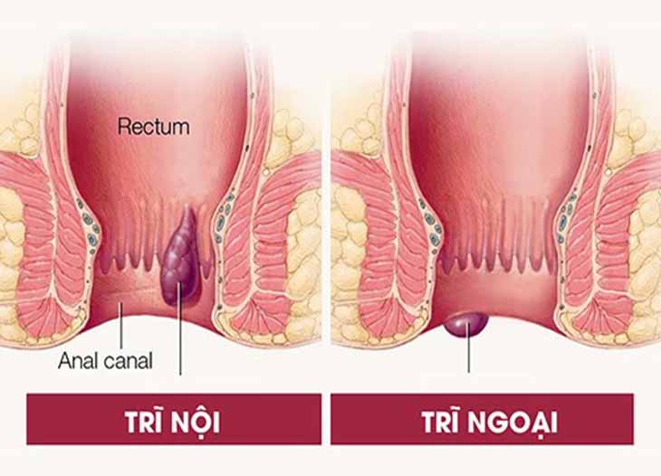 Bệnh trĩ có tự khỏi được không là câu hỏi của nhiều bệnh nhân?