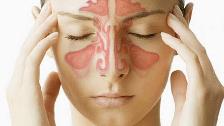 Viêm xoang mãn tính là tình trạng các xoang quanh mũi bị viêm và phù nề kéo dài từ 12 tuần trở lên