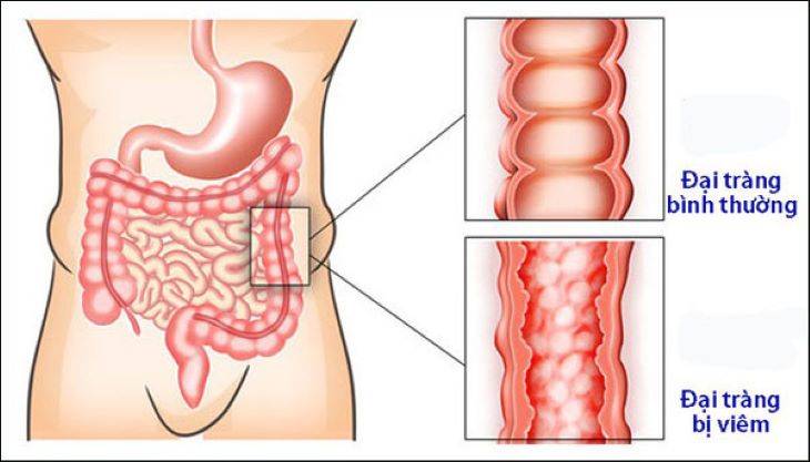 Nội soi sẽ gây ra nhiều đau đớn hơn nếu đại tràng của người bệnh đang trong tình trạng viêm nhiễm