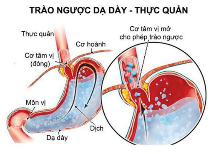 Ợ chua nôn ra máu do trào ngược dạ dày