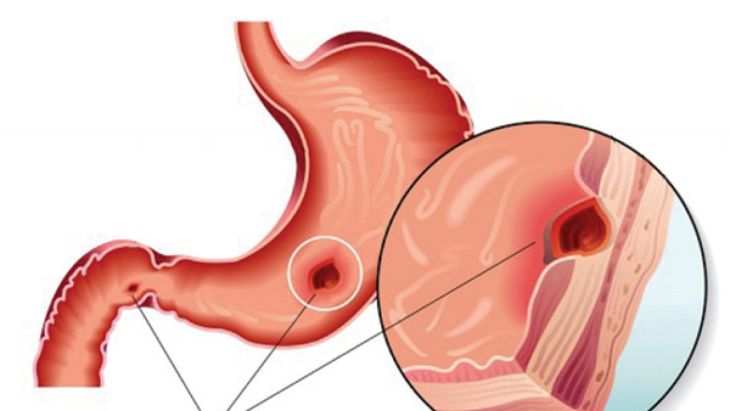 Thủng dạ dày là biến chứng nguy hiểm của hiện tượng ợ chua, buồn nôn