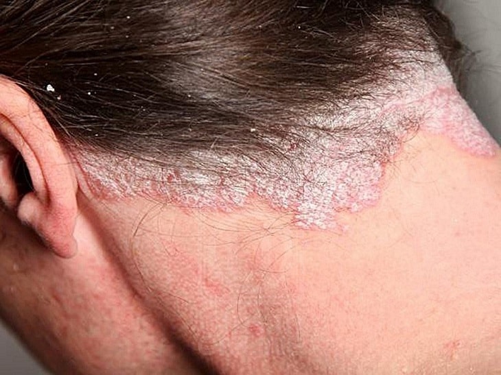 Vảy nến da đầu là một bệnh lý da liễu xảy ra khi tế bào da đầu tăng sinh bất thường