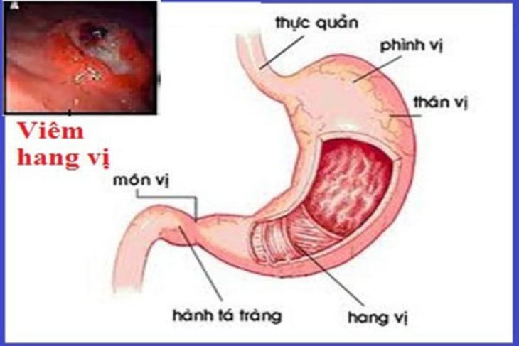 Viêm hang vị gây ra tình trạng ợ chua sau ăn