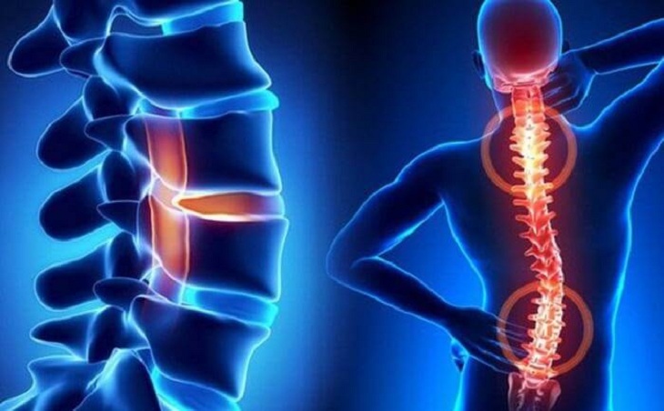 Bệnh lý xương khớp không chỉ gây đau lưng mà còn gây nguy hiểm cho sức khỏe
