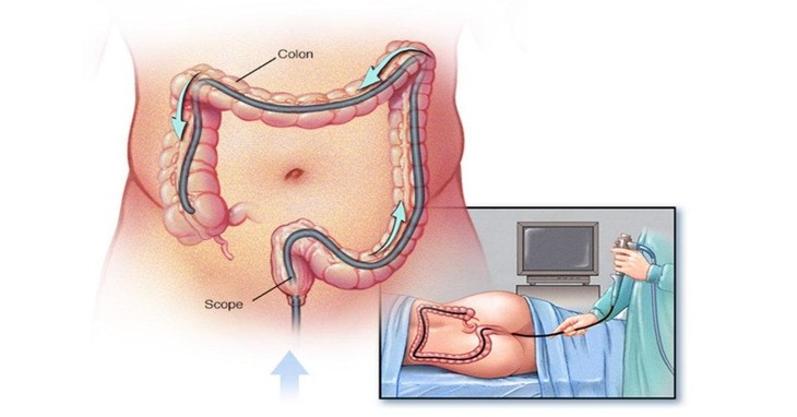 Nội soi đại tràng giúp bác sĩ chẩn đoán bệnh chính xác