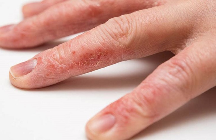 Bệnh tổ đỉa ở tay là một dạng của bệnh tổ đỉa khi các mụn nước mọc khu trú tại lòng bàn tay, kẽ ngón tay và rìa ngón tay