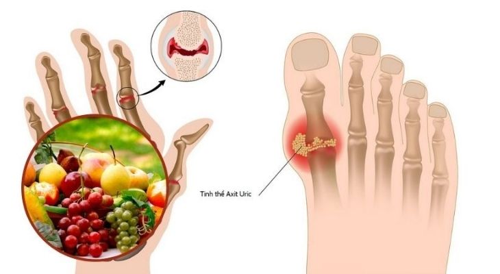 Bệnh gout nên ăn hoa quả gì