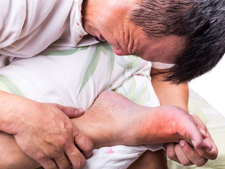 Bệnh gout gây ra cơn đau ở các khớp xương