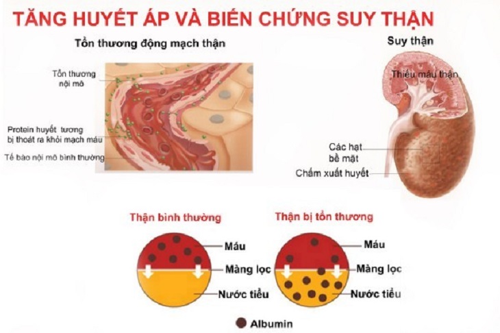 Suy thận gây tăng huyết áp là biến chứng khó lường và nguy hiểm