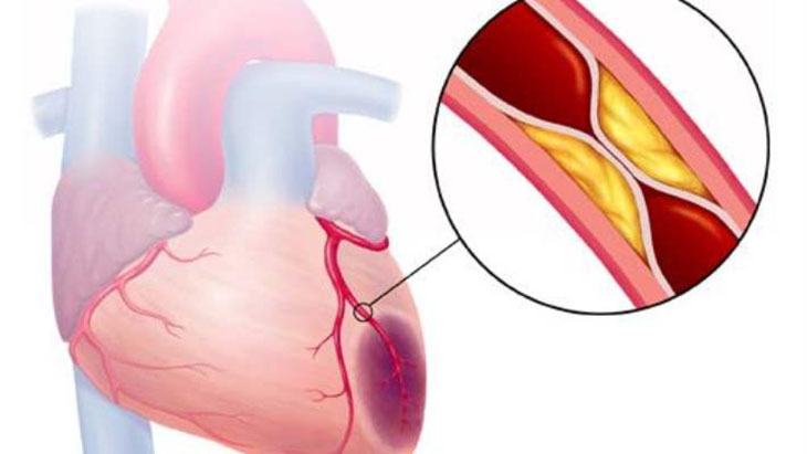 Chụp động mạch chủ được thực hiện khi thông tim trái