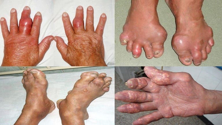 Gout gây nhiều biến chứng nguy hiểm